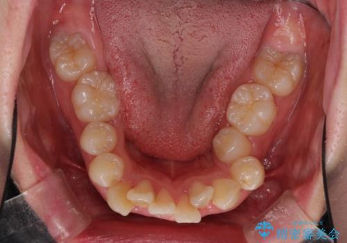 著しい叢生と顎骨のズレ ワイヤー装置による抜歯矯正の治療前