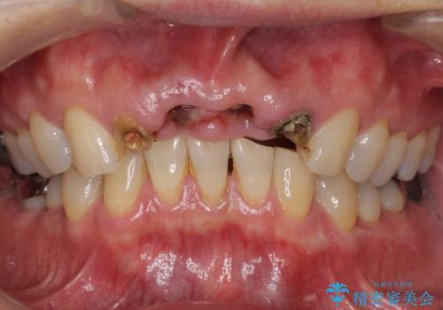 転んで前歯が2本ぬけた 自然なブリッジへ 60代男性の治療前