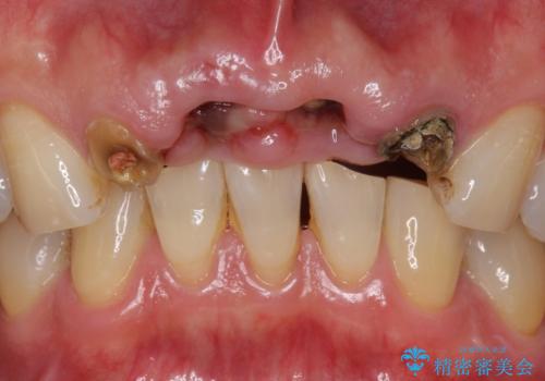 転んで前歯が2本ぬけた 自然なブリッジへ 60代男性の治療前