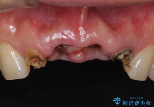 転んで前歯が2本ぬけた 自然なブリッジへ 60代男性の治療前