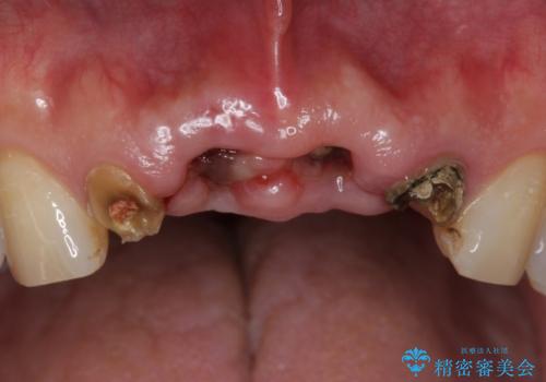 転んで前歯が2本ぬけた 自然なブリッジへ 60代男性の治療前