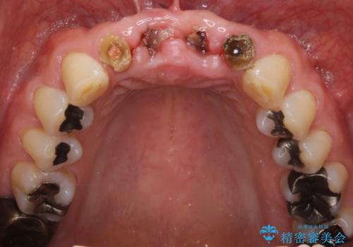 転んで前歯が2本ぬけた 自然なブリッジへ 60代男性の治療前
