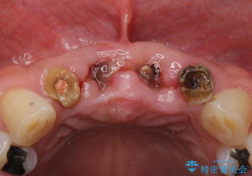 転んで前歯が2本ぬけた 自然なブリッジへ 60代男性の治療前