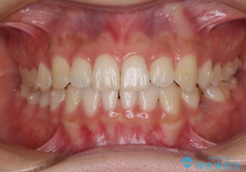 乳歯を抜いてインプラントに 咬み合わせ改善のインビザライン矯正の治療中