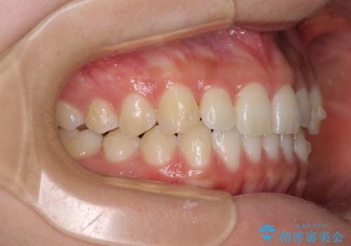 乳歯を抜いてインプラントに 咬み合わせ改善のインビザライン矯正の治療中