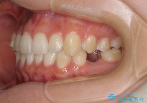 乳歯を抜いてインプラントに 咬み合わせ改善のインビザライン矯正の治療中