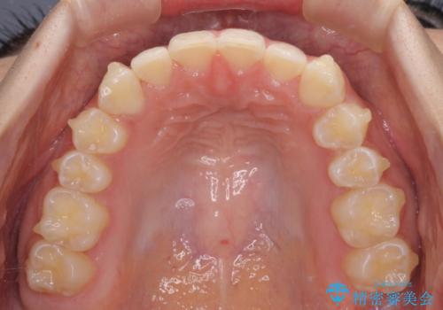 乳歯を抜いてインプラントに 咬み合わせ改善のインビザライン矯正の治療中