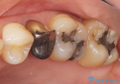 歯が欠けた セラミッククラウンで綺麗に 40代女性の治療前