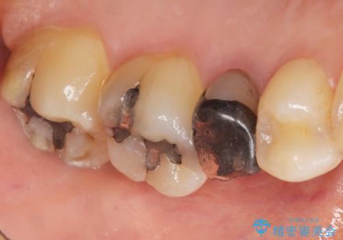 歯が欠けた セラミッククラウンで綺麗に 40代女性の治療前