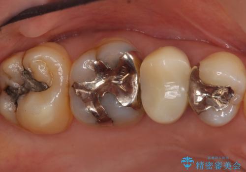 歯が欠けた セラミッククラウンで綺麗に 40代女性の治療前