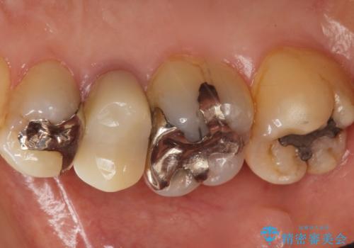 歯が欠けた セラミッククラウンで綺麗に 40代女性の治療前