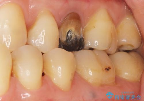 歯が欠けた セラミッククラウンで綺麗に 40代女性の症例 治療前