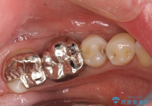 金属を白くしたい、セラミックへの症例 治療前