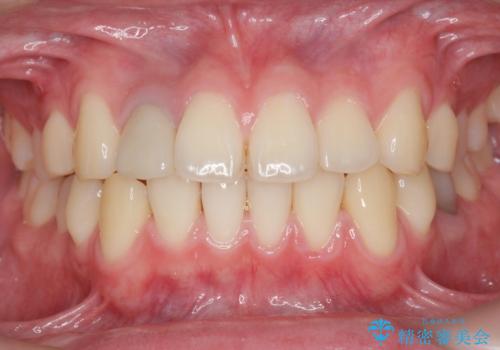 他院で入れたセラミッククラウンの色が気に入らない 20代男性の治療前