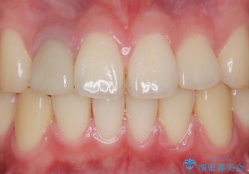 他院で入れたセラミッククラウンの色が気に入らない 20代男性の治療前