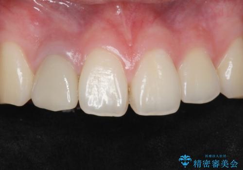 他院で入れたセラミッククラウンの色が気に入らない 20代男性の症例 治療前