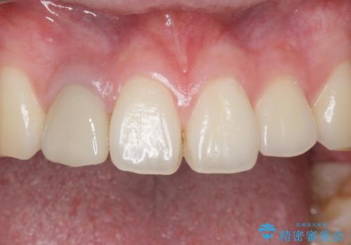 他院で入れたセラミッククラウンの色が気に入らない 20代男性の治療前