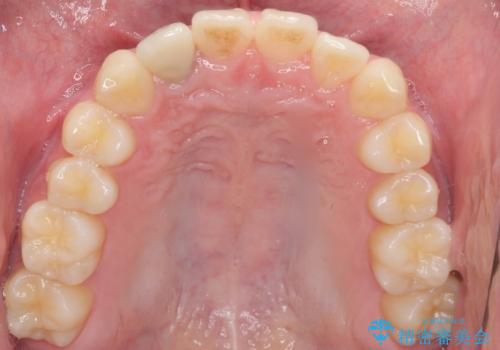 他院で入れたセラミッククラウンの色が気に入らない 20代男性の治療前