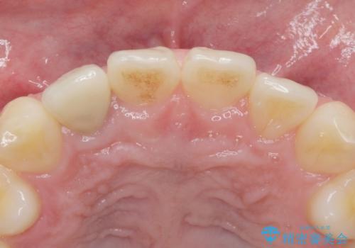 他院で入れたセラミッククラウンの色が気に入らない 20代男性の治療前