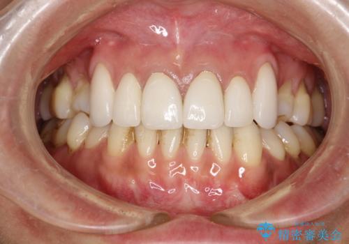 前歯のかぶせ物をオールセラミックへ　形を含めて理想の前歯への治療後
