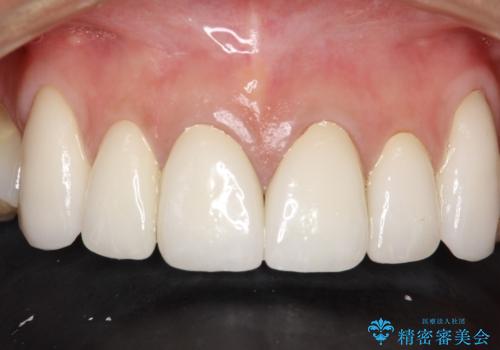 前歯のかぶせ物をオールセラミックへ 形を含めて理想の前歯への治療後