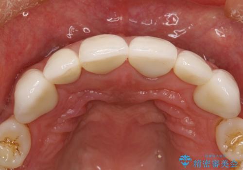 前歯のかぶせ物をオールセラミックへ 形を含めて理想の前歯への治療後