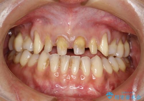 前歯のかぶせ物をオールセラミックへ　形を含めて理想の前歯への治療中