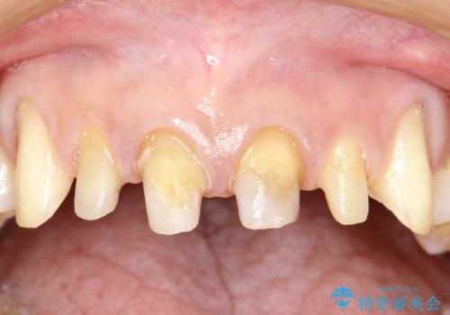 前歯のかぶせ物をオールセラミックへ 形を含めて理想の前歯への治療中