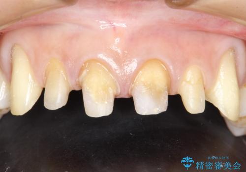 前歯のかぶせ物をオールセラミックへ　形を含めて理想の前歯への治療中