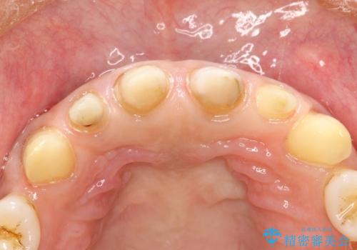 前歯のかぶせ物をオールセラミックへ 形を含めて理想の前歯への治療中