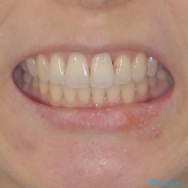 短期間で仕上げたい ワイヤーでの非抜歯矯正の治療後(顔貌)