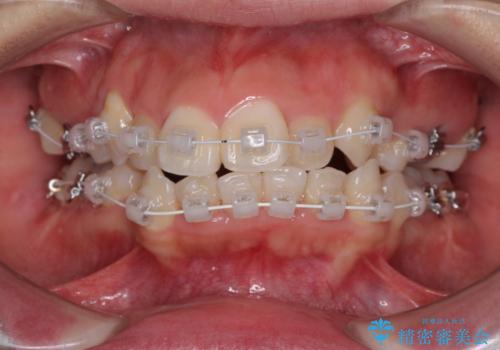 著しい叢生と顎骨のズレ　ワイヤー装置による抜歯矯正の治療中