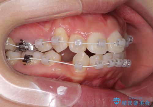 著しい叢生と顎骨のズレ ワイヤー装置による抜歯矯正の治療中