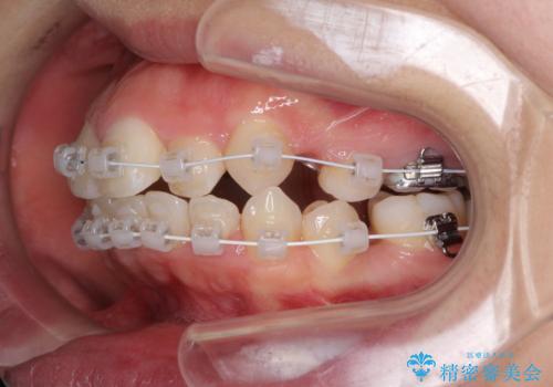 著しい叢生と顎骨のズレ　ワイヤー装置による抜歯矯正の治療中
