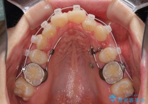 著しい叢生と顎骨のズレ ワイヤー装置による抜歯矯正の治療中