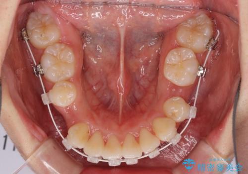 著しい叢生と顎骨のズレ ワイヤー装置による抜歯矯正の治療中