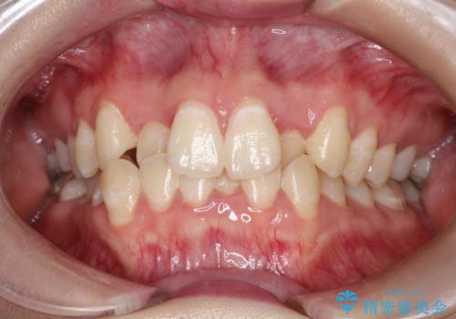 前歯が前後反対にかんでいる　インビザラインによる矯正の症例 治療前