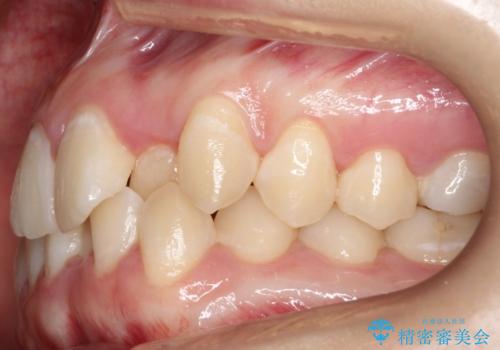 前歯が前後反対にかんでいる インビザラインによる矯正の治療前