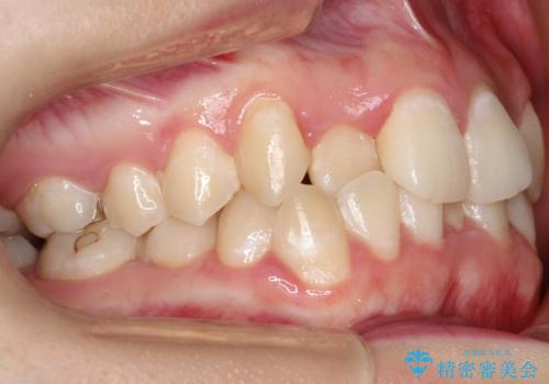 前歯が前後反対にかんでいる インビザラインによる矯正の治療前