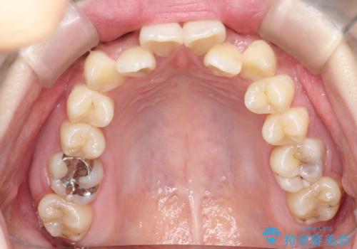 前歯が前後反対にかんでいる　インビザラインによる矯正の治療前