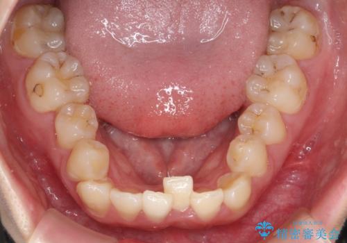 前歯が前後反対にかんでいる インビザラインによる矯正の治療前