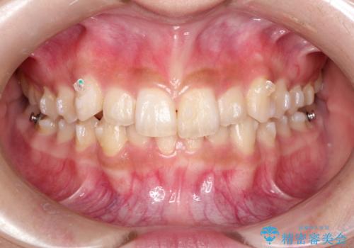 インビザラインを使用した深いかみ合わせの矯正の治療中