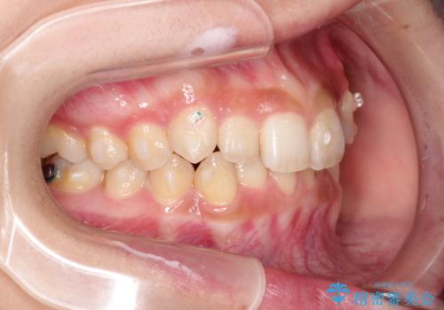 インビザラインを使用した深いかみ合わせの矯正の治療中