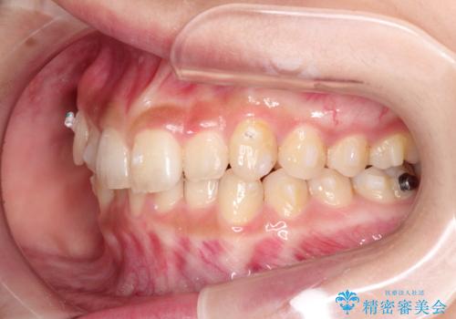 インビザラインを使用した深いかみ合わせの矯正の治療中