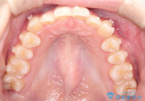 インビザラインを使用した深いかみ合わせの矯正の治療中