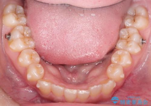 インビザラインを使用した深いかみ合わせの矯正の治療中