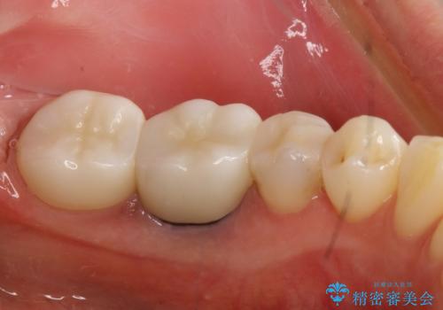 金属を白くしたい、セラミックへの治療後