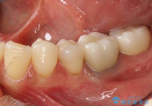 金属を白くしたい、セラミックへの治療後