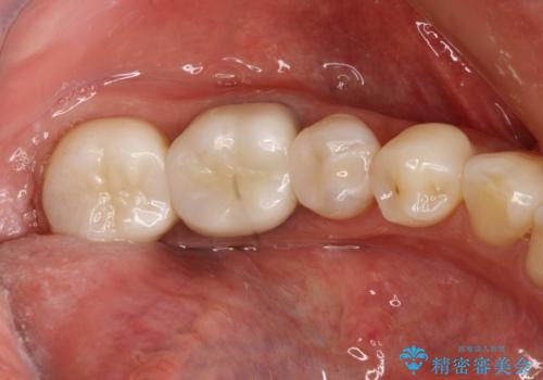 金属を白くしたい、セラミックへの症例 治療後