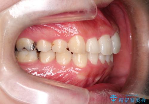 全体のガタガタをインビザラインできれいな歯並びへの治療後